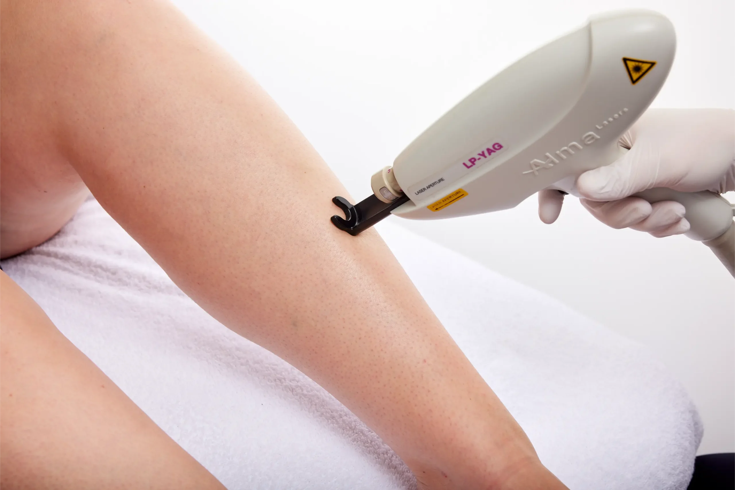 Laserontharing benen Huidkliniek Gaaf